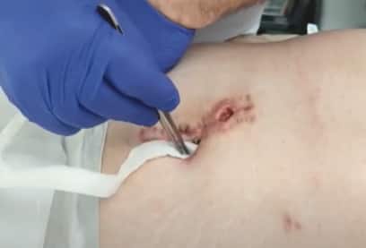 Biatain® Fiber en dehiscencia abdominal. Fácil de utilizar, aún en heridas muy complejas.