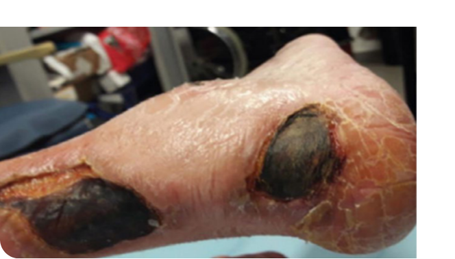 Lesiones en miembro inferior por artritis reumatoide