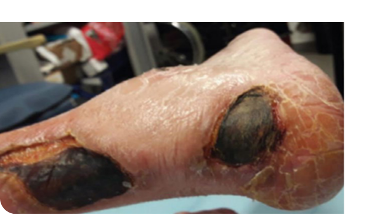 Lesiones en miembro inferior por artritis reumatoide