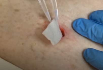 Biatain® Fiber en herida quirúrgica. Óptimo tratamiento aún en heridas pequeñas y profundas.