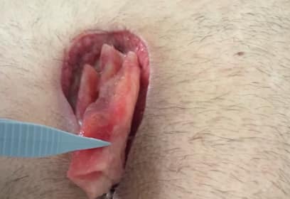 Biatain® Fiber en sinus pilonidal. Gestión óptima del exudado y poder de limpieza en heridas difíciles de tratar.