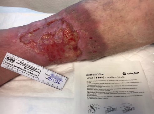 Infected traumatic wound on the lower leg