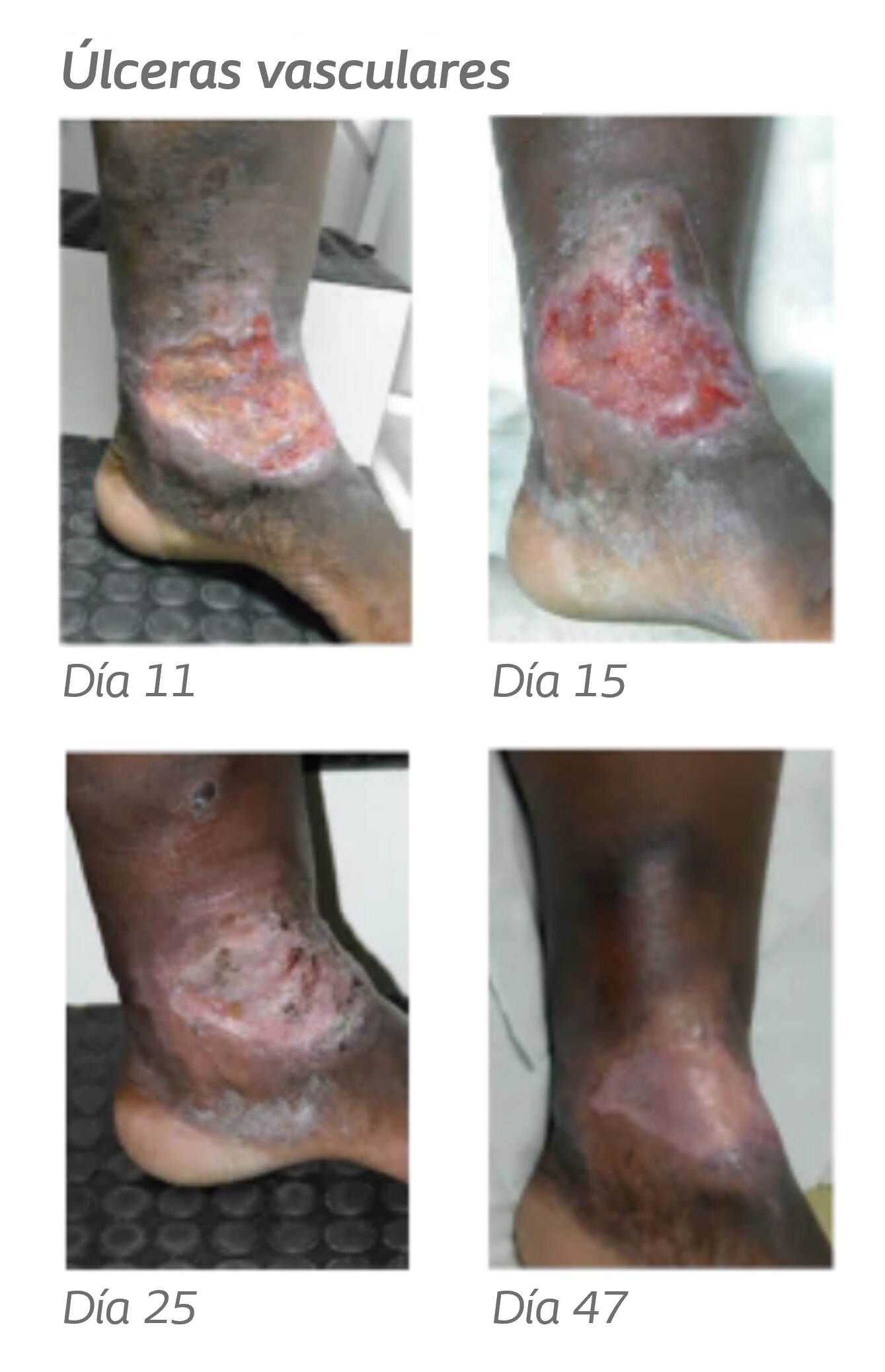 Venous leg ulcer healing process 530x530.png