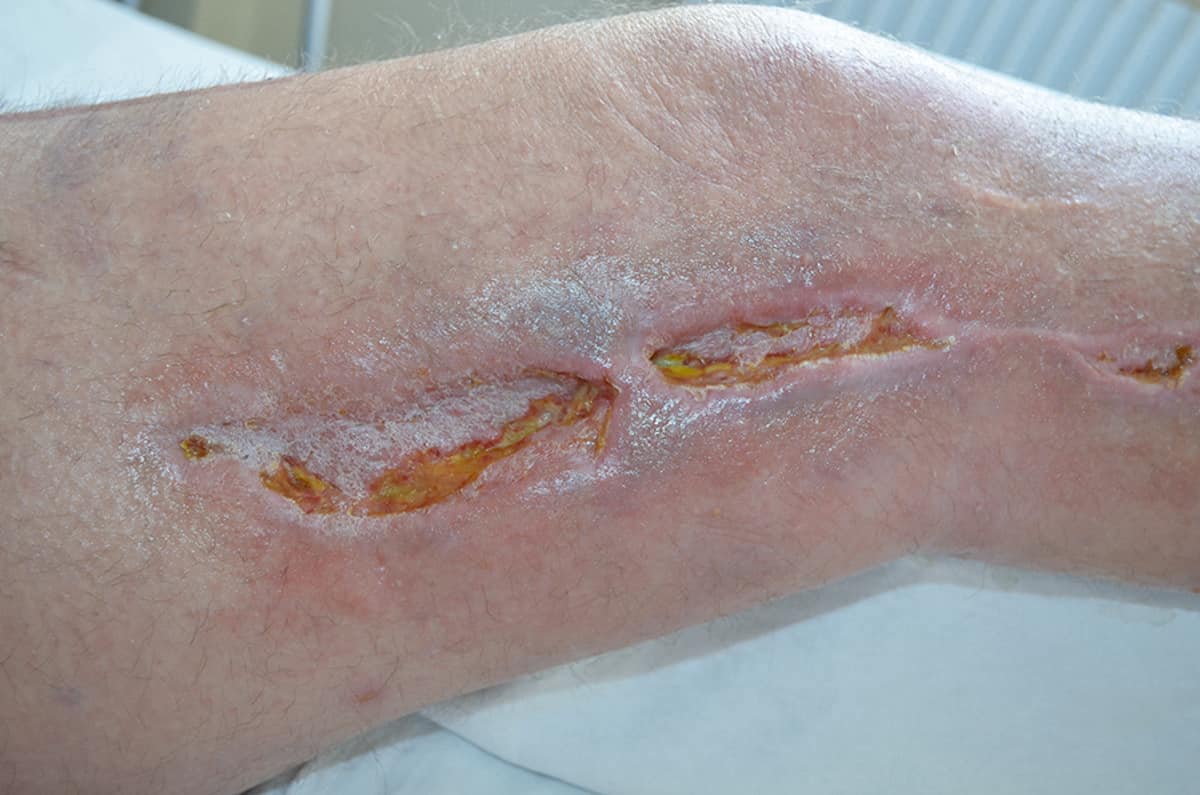 ¿Cuáles son los beneficios de los apósitos de plata?