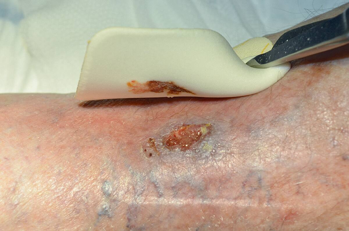 ¿Cuáles son los beneficios de los apósitos de espuma?