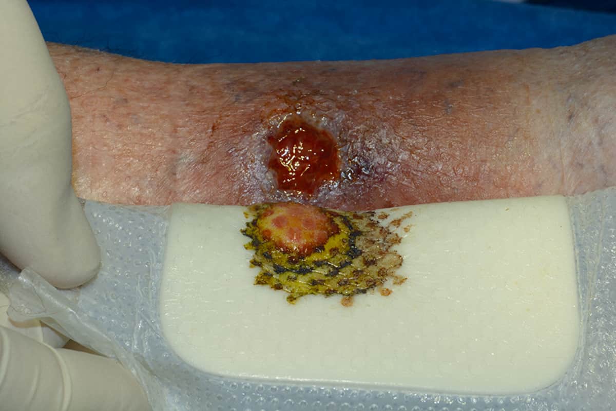 Cómo usar los apósitos de plata