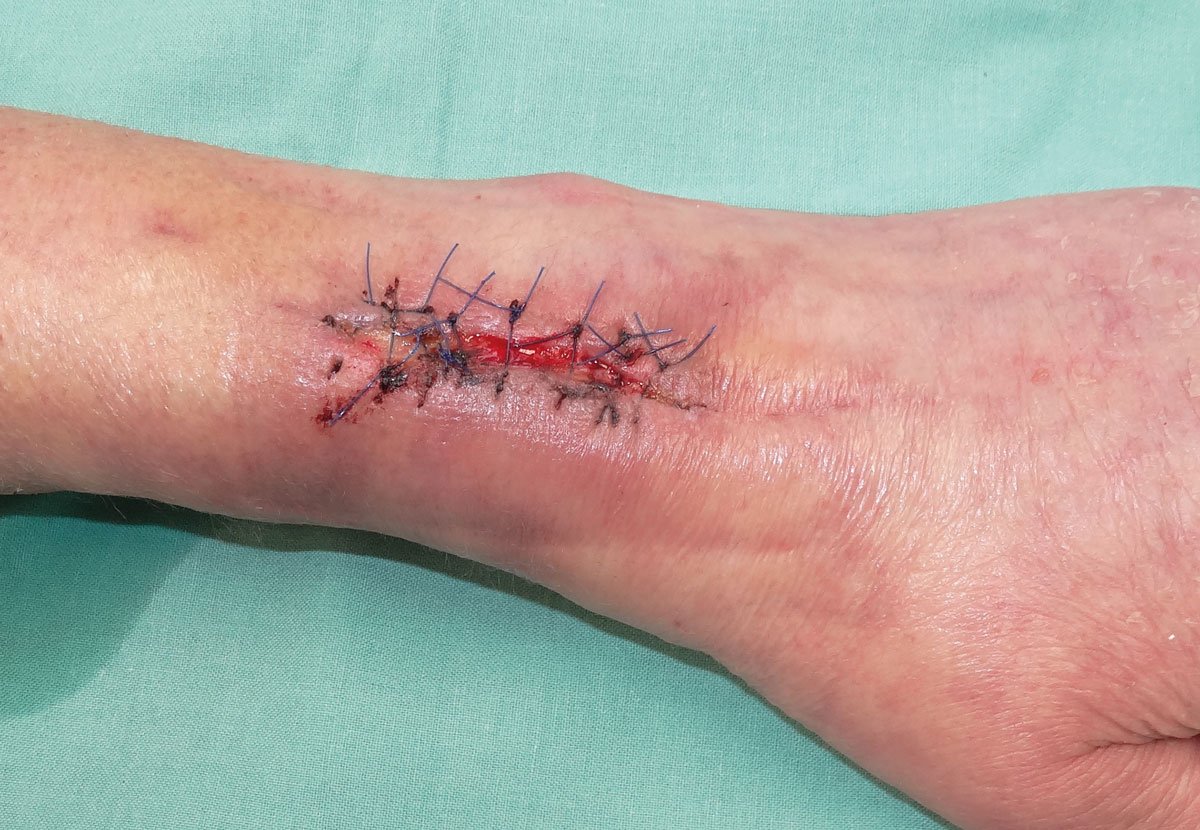 CP-WSC-Postoperative-wound-hand-Biatain-Contact.jpg