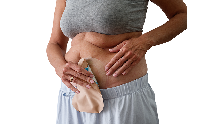 Ostomía